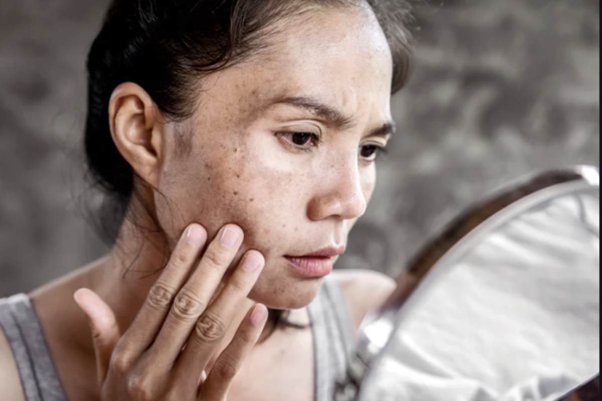 Il melano-aging rappresenta una frontiera innovativa nel trattamento di macchie sul viso e invecchiamento cutaneo