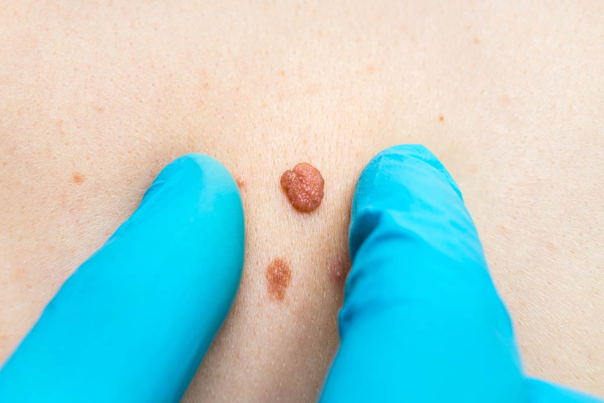 tumore pelle sintomi